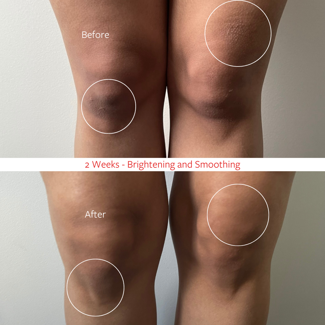 Elbow and Knee Treatment