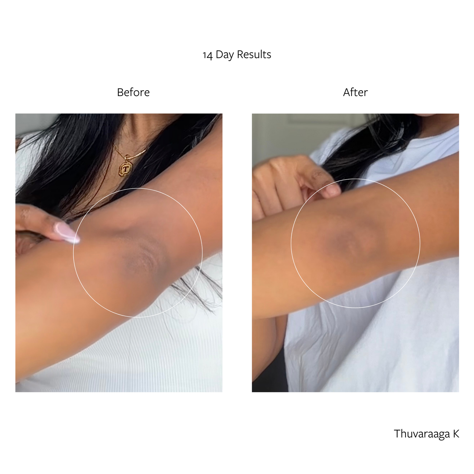 Real brightening results for brighter elbow skin using Skovsona's Brightening Duo